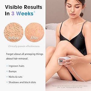 Oreeth IPL Laser Hair Removal Device for Women & Men - Home 45F Ice-Cooling Contact for Painless & Long-Lasting Results, 86% Hair Reduction in 3 Weeks for Full Body & Bikini Line, Rose Gold