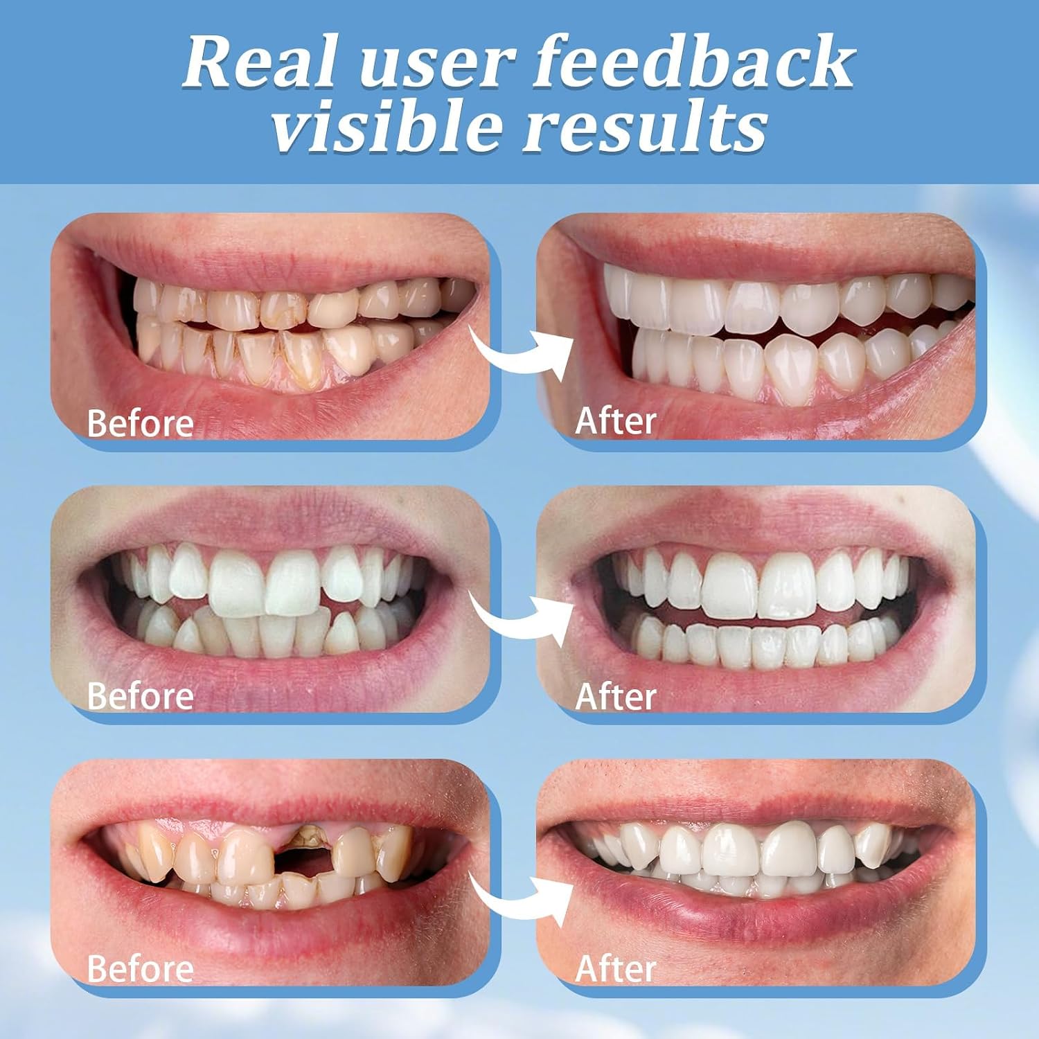 Veneers Teeth for Women,Temporary Cosmetic Confident Smile | Nature and Comfortable Regain Confidence Smile,Temporarily Adjustable,2 PCS