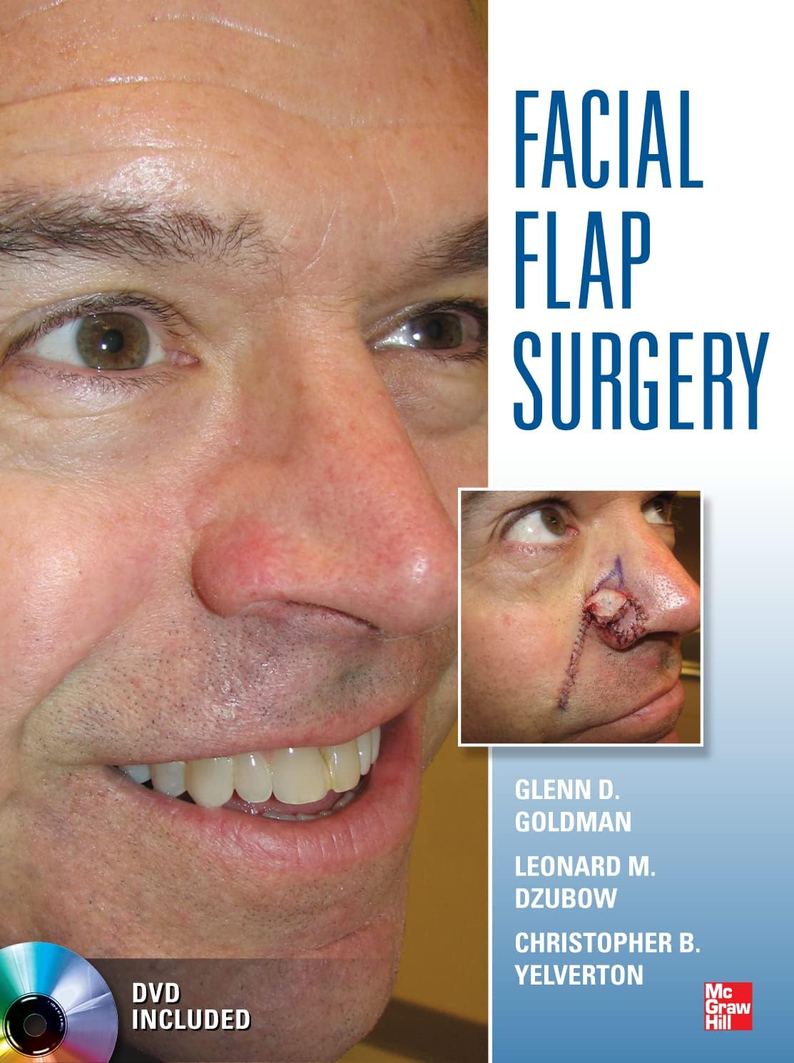 Facial Flaps Surgery 1st Edition