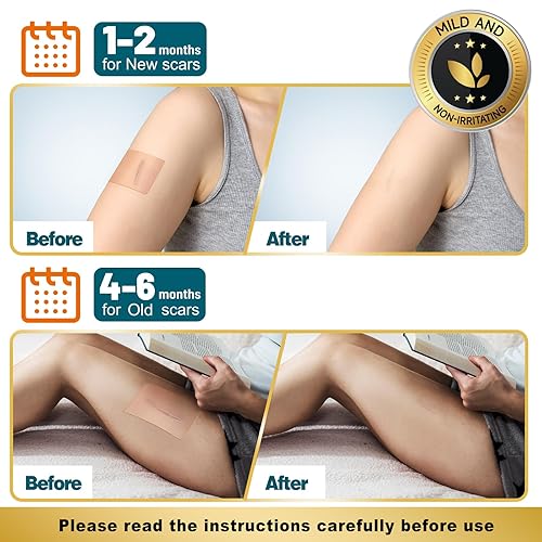 Miniatura 5 de Aheroi Cinta de silicona para cicatrices, hojas de silicona de 1.6 x 200 pulgadas (2 rollos a 16.4 ft), hojas de cicatrices de grado médico para