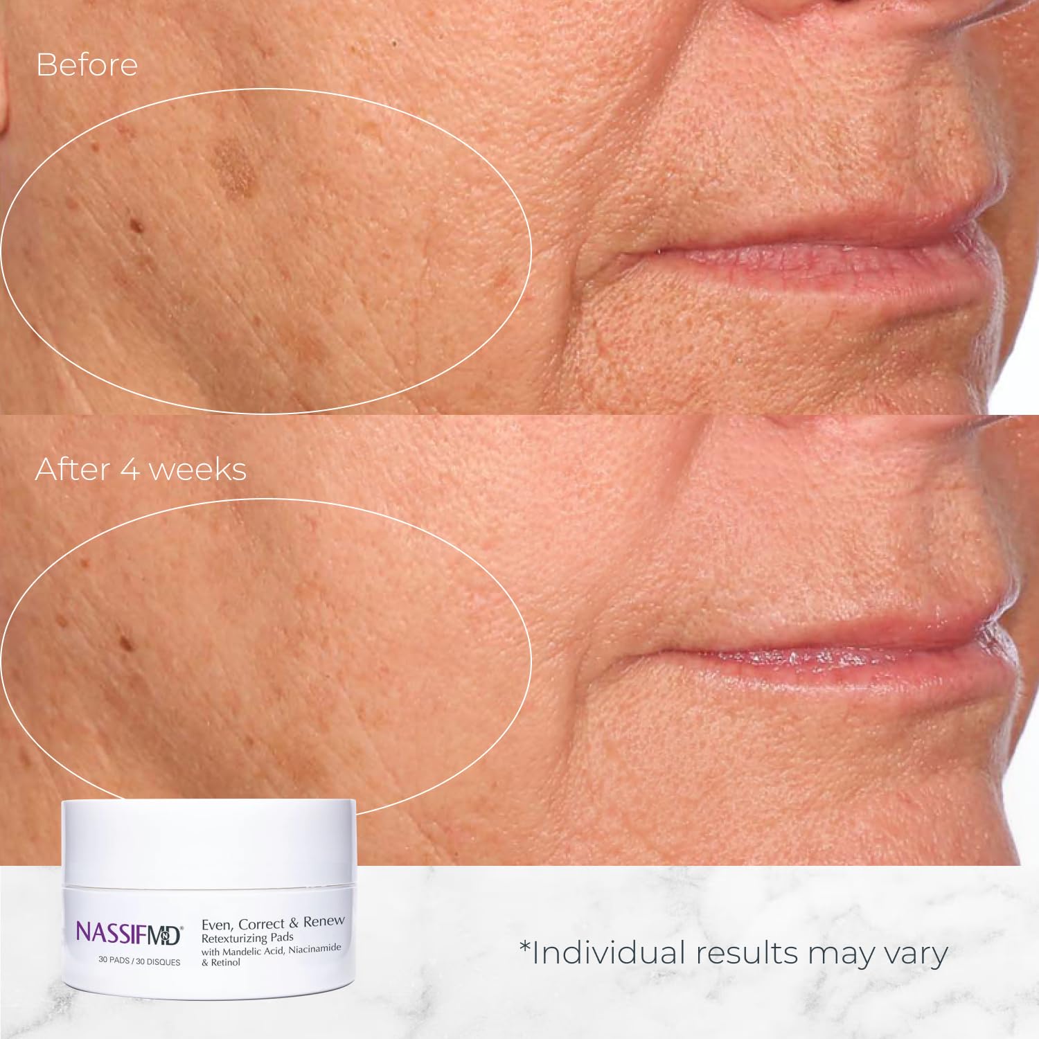 NassifMD Even, Correct & Renew Retexturizing Pads | Chemical Peel for Face | Whitehead, Closed Comedone and Acne Marks Skin Resurfacing Pads | Hyperpigmentation Treatment for Face