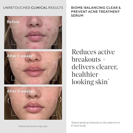 Acne Treatment Trial Kit Salicylic Acid & Mandelic Acid for Clear Skin Oil Control, Spot Treatment & Cleanser Travel Size Skincare for Acne-Prone Skin