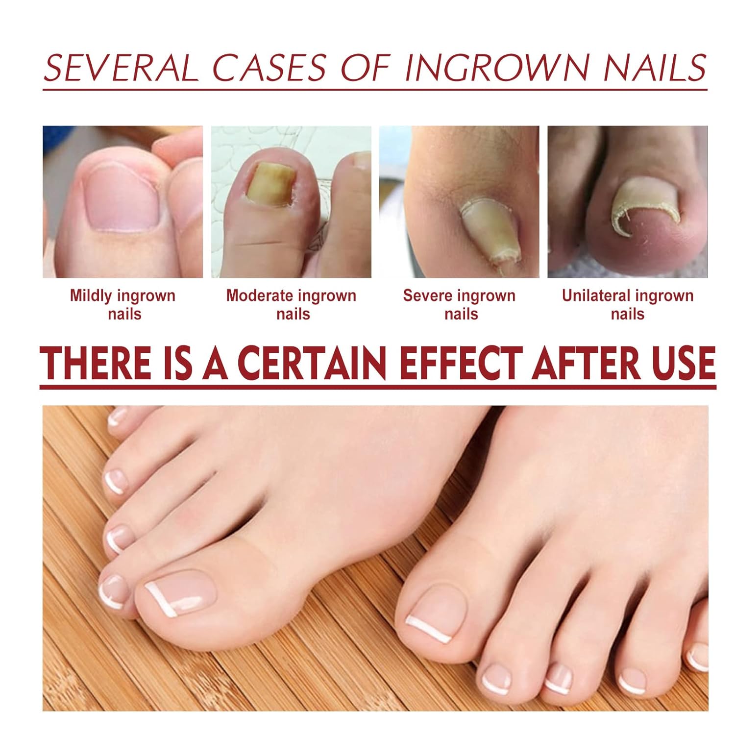 German Toenail Plus Anti Paronychia Relief Oil, German 2024 New Toenailplus™ Anti Paronychia Relief Oil, Anti Paronychia Relief Oil for Toenail Care, Best Nail Repair Solution (5PCS)