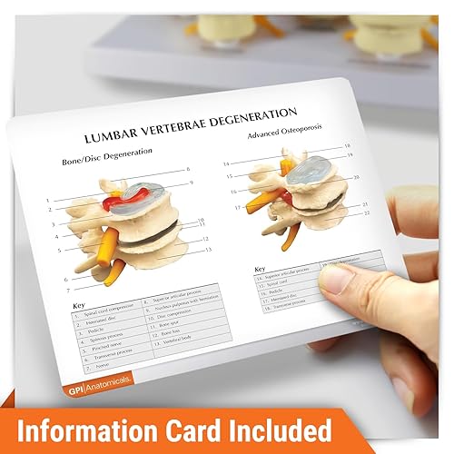 Miniatura 4 de Modelo de columna vertebral  Réplica de anatomía corporal humana de condiciones de vértebras de cuatro etapas para médicos herramienta educativa de