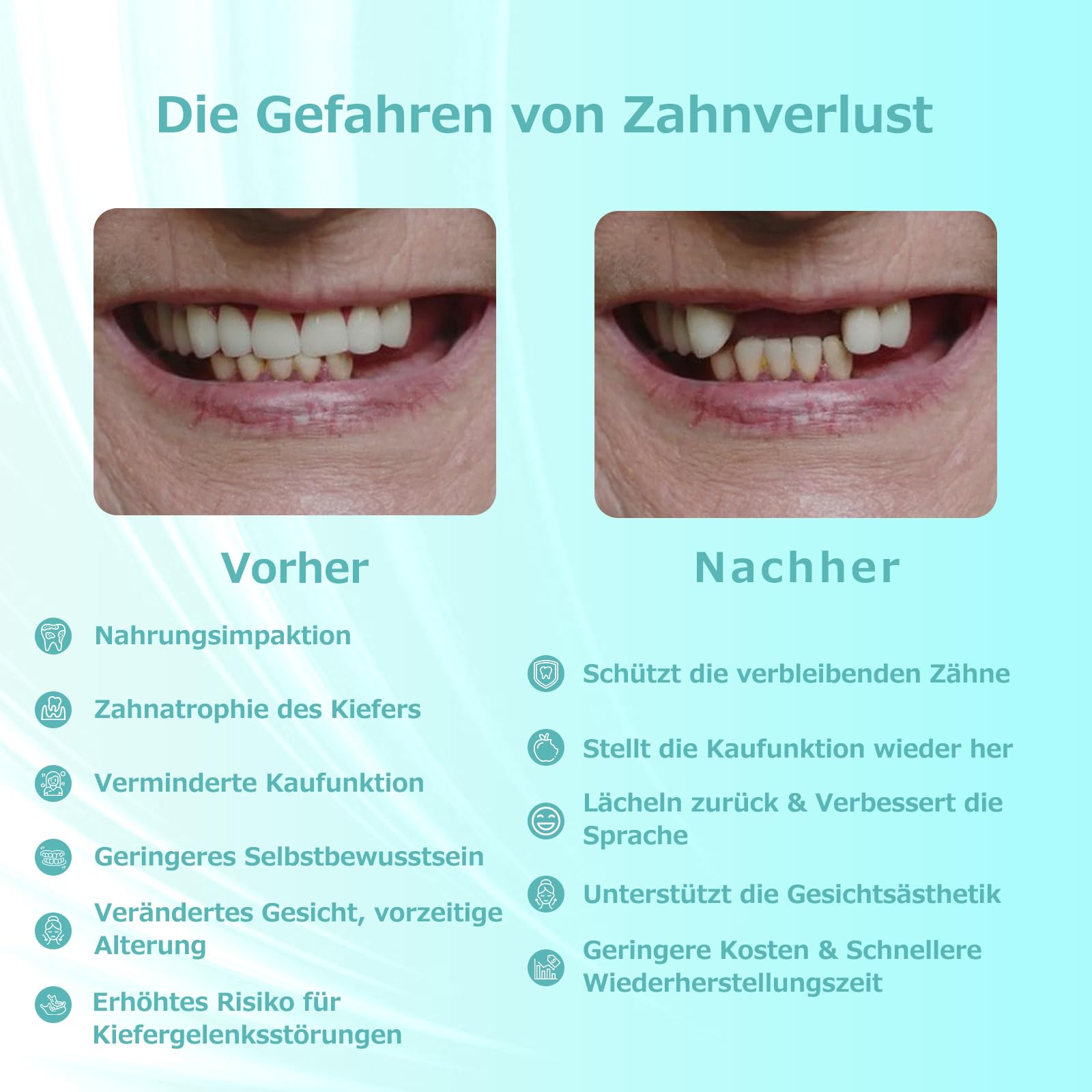 Prothèse Partielle Dentaire sur mesure - Dentier Provisoire, Prothese dentaire amovible et provisoire. Ajustement parfait et utilisation facile pour recréer votre sourire à domicile (3 dents)