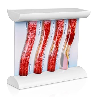 SimCoach Low-Density Lipoprotein LDL Blood Vessel Model for Medical Patient Doctor Teaching, Vascular Demonstration Training Tool, Large Size