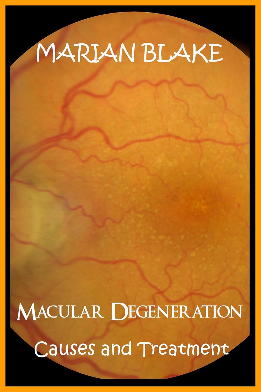 Macular Degeneration Causes and Treatment (Your Eyes Book