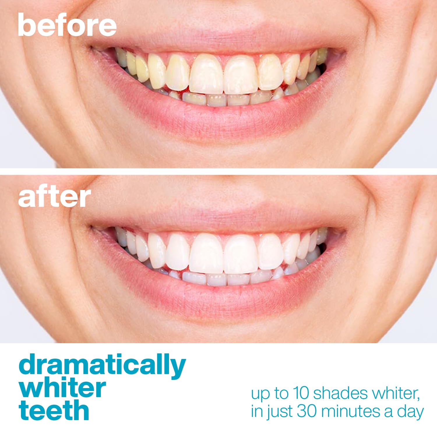 Aquasonic Teeth Whitening Strips - Dentist Quality - Easy Safe and Affordable Teeth Whitening - Fast Gentle Effective Whitening Strips for Teeth - Instant Results