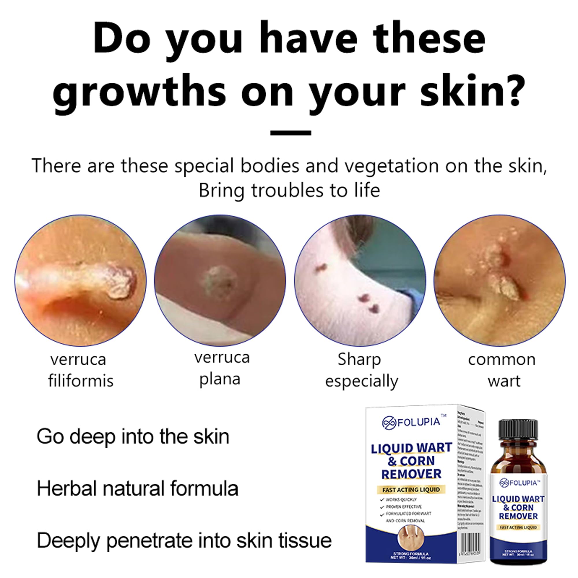 Kit para eliminar verrugas 30ml, lunares y callosidades, líquido para eliminar lunares y verrugas en cuerpo y manos