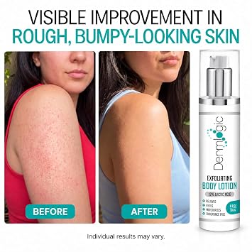 Dermlogic Keratosis Pilaris Treatment 12% Lactic Acid Exfoliating Body Lotion for KP, Strawberry Legs, Rough, Dry, Cracked, Bumpy Skin & Redness Moisturizing Repair Cream, 6.9 oz