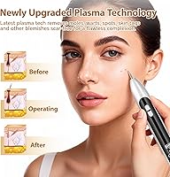 Vista 7 de Nodhaul Effective Maximum Strength WART Remover,Mole and Wart Removal Pen,Dark Spot Removal for Face and Body