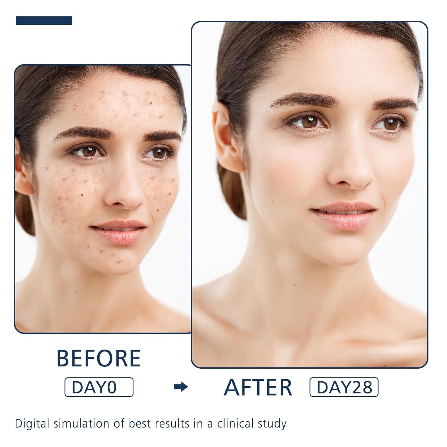 Dark Spot Remover for Face and Body - Dark Spot Advanced Corrector Serum for Melasma, Age Spots, Freckles & Sun Spots with 360° Roller for All Skin Types 0.67floz - Image 5