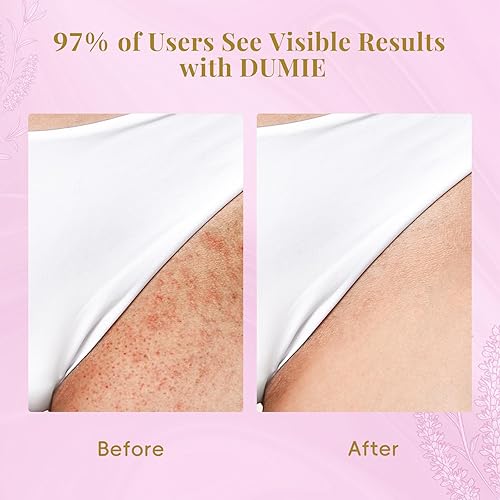 Miniatura 5 de Cyperus Rotundus Serum Roll-On  Tratamiento de pelo encarnado y protuberancia de afeitar, inhibidor natural del crecimiento del cabello y solución