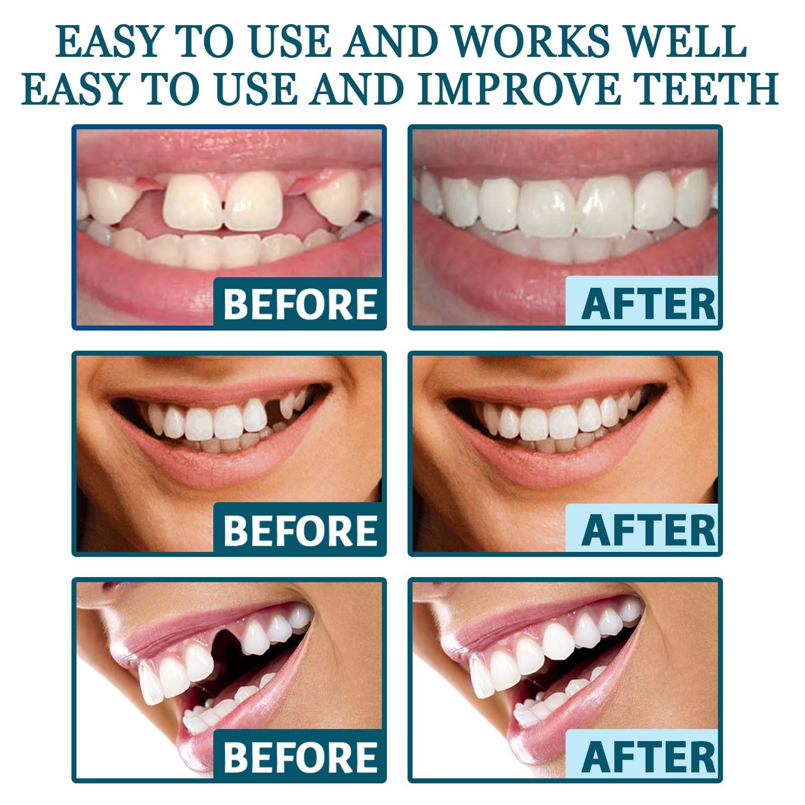 Protesi con fibbia regolabile, allineatori di denti invisibili, protesi in silicone ultrasottili e dall'aspetto naturale per uomini e donne (1 PCS)
