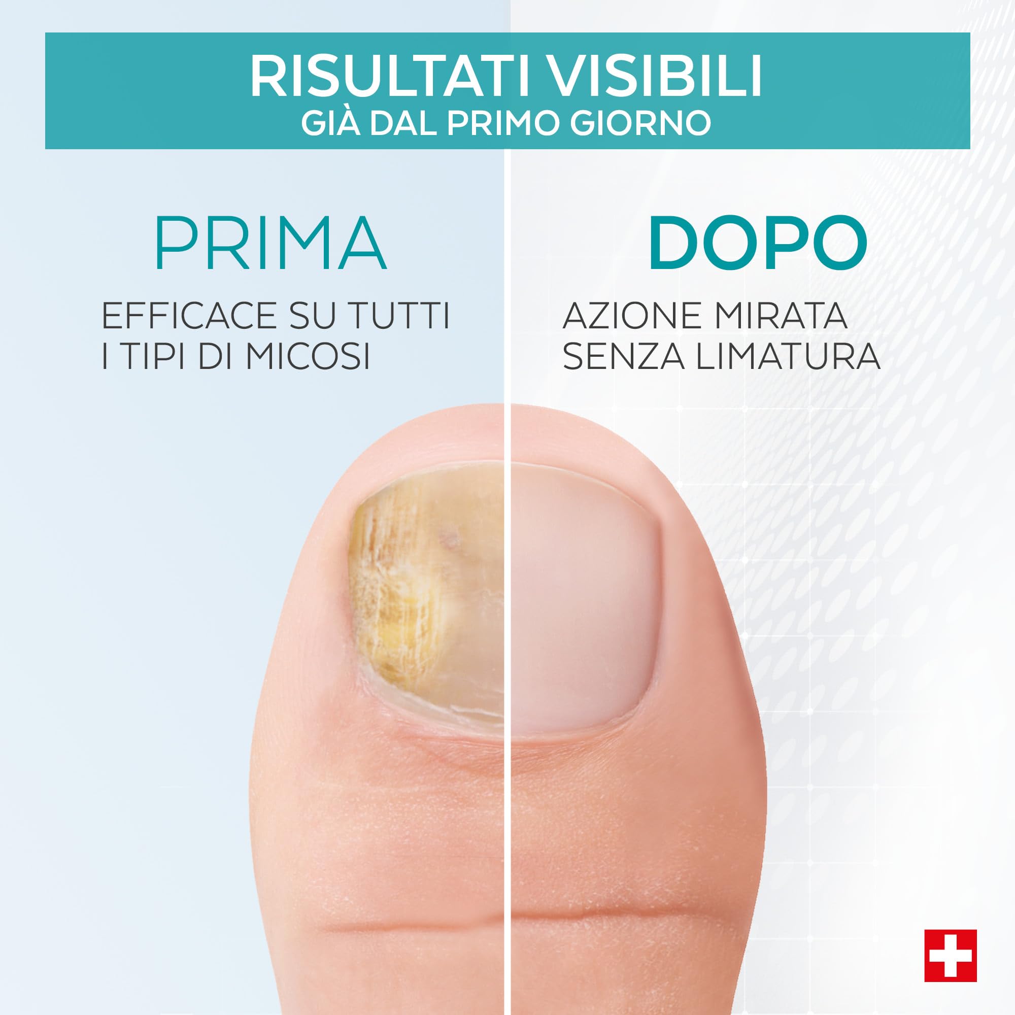 Poderm Penna Siero per il Trattamento della Micosi delle Unghie – Sviluppata da un Podologo – Prodotta in Svizzera – Penna Supplend per la Cura delle Unghie di Mani e Piedi – Trattamento per Infezioni