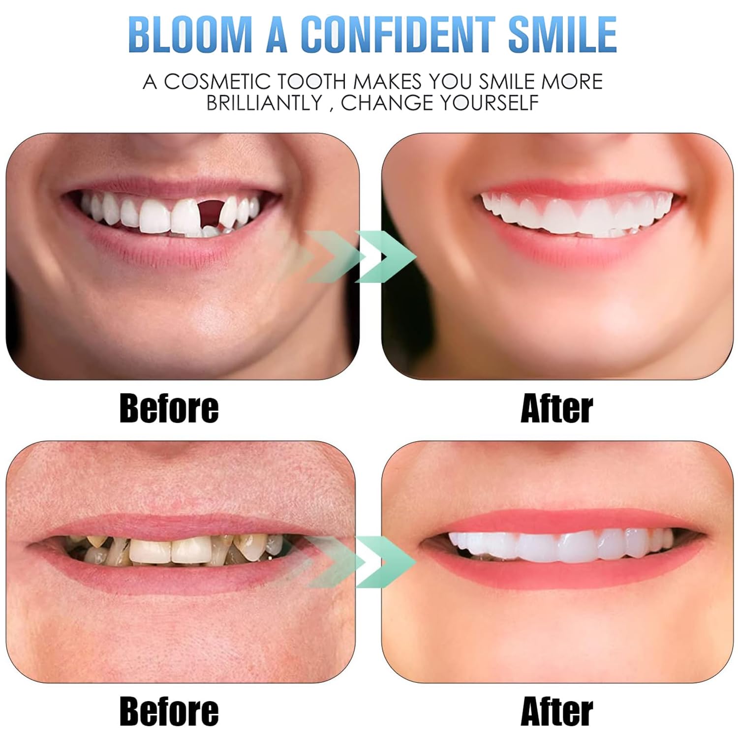 2 Pares Dientes de Carillas Cosméticos, Reutilizable Cómoda Dientes Temporales de Superior e Inferior para Hombre Mujer Blanqueamiento Dental Cubrir Los Dientes Defectuosos