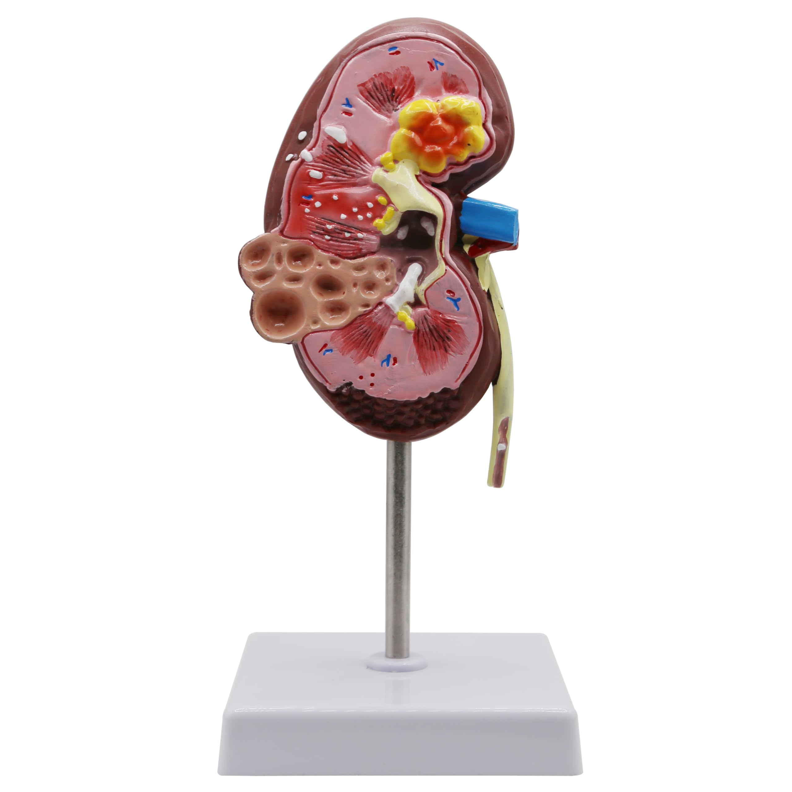 DRXRD Kidney Model Kidney Pathological Model, 3D Kidney Diseases Model with Digital Anatomical Location Identification and Anatomical Position Diagram for Teaching Demonstration and Explanation