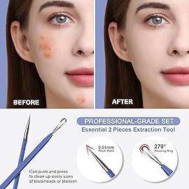 Teenitor Pimple Extractor Acne Treatment Surgical Grade Blackhead Comedone Removal 2-in-1 Popper Tool for Face Nose (Blue)