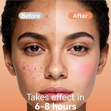 Microdart Pimple Patches for Face, Hydrocolloid Zit Patches with Salicylic Aci, Translucent Zits Stickers for Early Stage Acne and Deep Blemishes, 6 Count