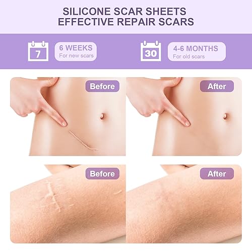 Miniatura 3 de Hojas de silicona para cicatrices, cinta de silicona para cicatrices quirúrgicas, tiras de eliminación de golpes queloides para estrías, sección C y