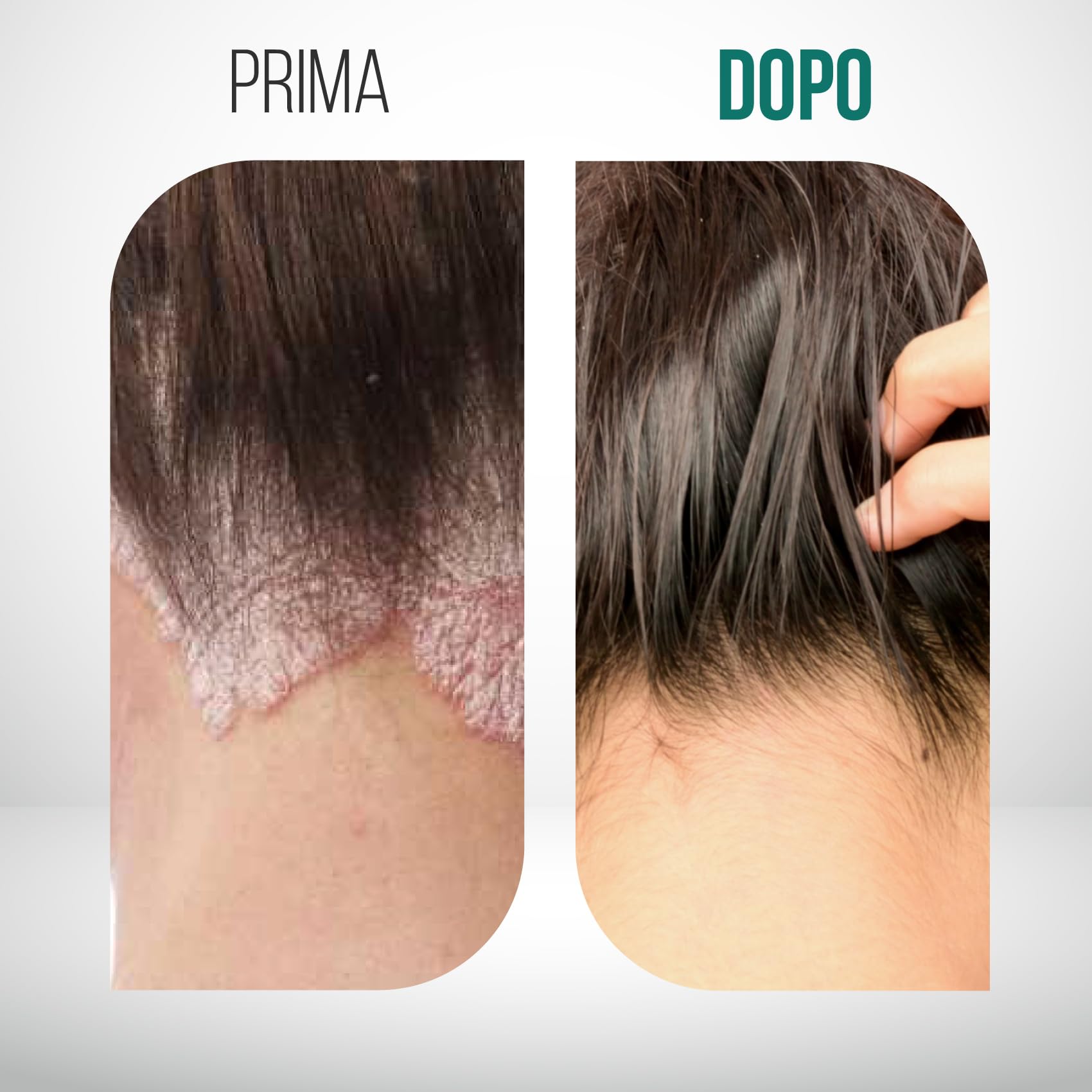 Sebo EVO spray sublinguale per carenza di Biotina (Vitamina B8). Garantito massimo assorbimento del principio attivo. Contrasta dermatite seborroica, dermatite atopica, acne, indebolimento dei capelli