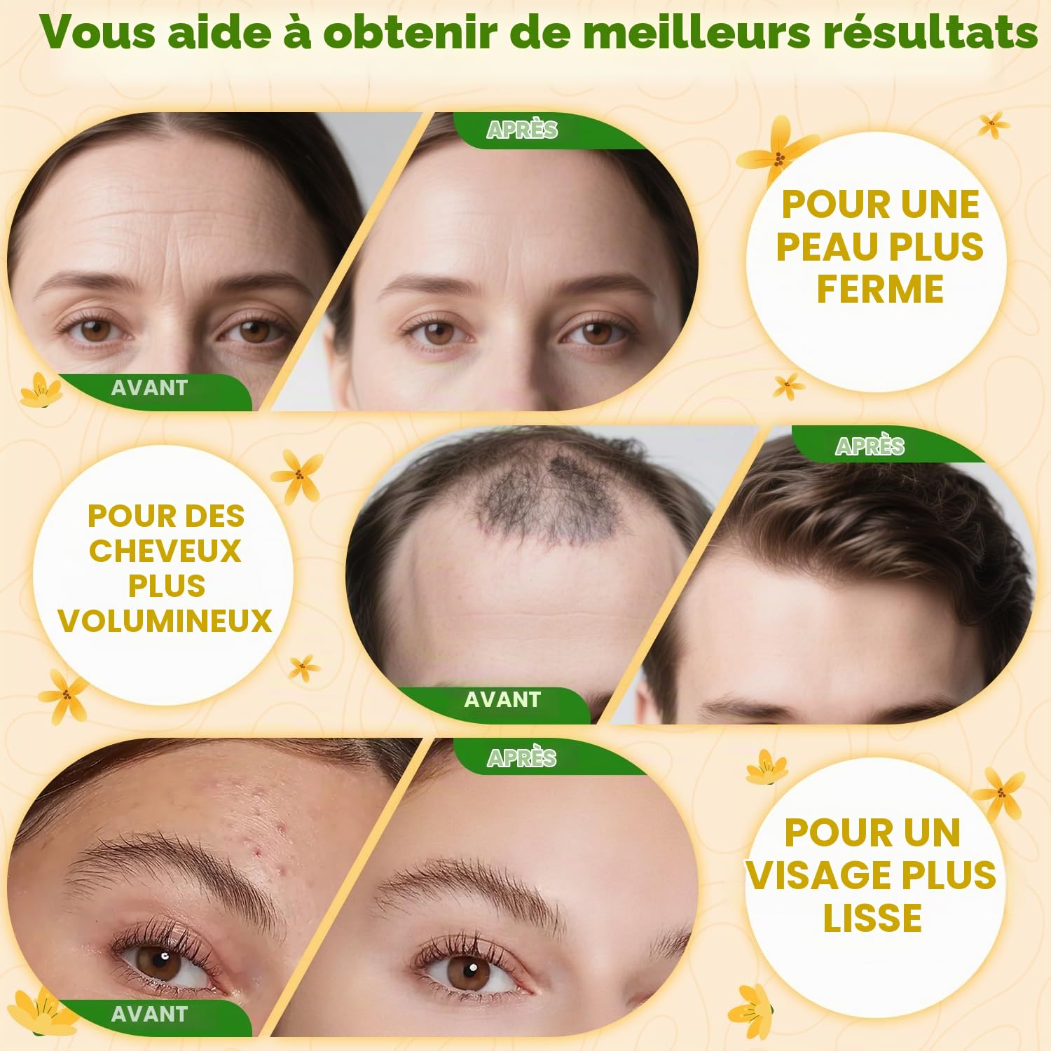 Appareil Haute Frequence Esthetique, ROMMQB Portable Haute Fréquence Visage