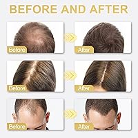 Vista 5 de Suero para el crecimiento del cabello de minoxidil al 5% para hombres y mujeres, para el tratamiento del crecimiento del cabello y la barba - 1.0 fl