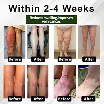 Fluidease Leg Therapy Edema Cream, Fluid Ease Leg Therapy Cream, Lymphatic Drainage Massage Cream, Care Lymphatic Massage Cream, Edema Relief for Legs and Feet (1)