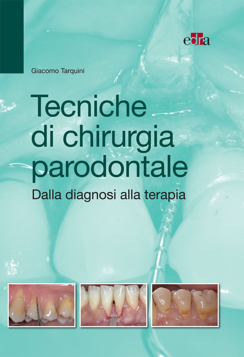 Tecniche di chirurgia parodontale: Dalla diagnosi alla terapia (Italian Edition)