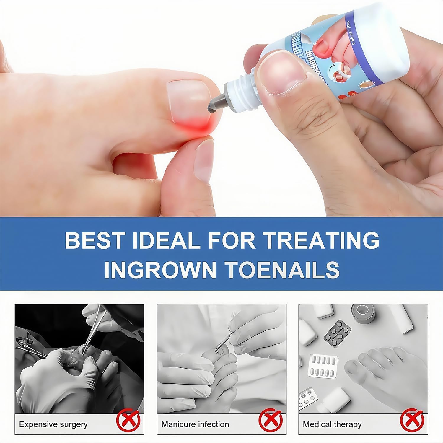Ingrown Toenail Treatments, Ingrown Nail Treatment for Toenails Extra-Strong, Ingrowning Toenail Treatment, 20ml - Image 3