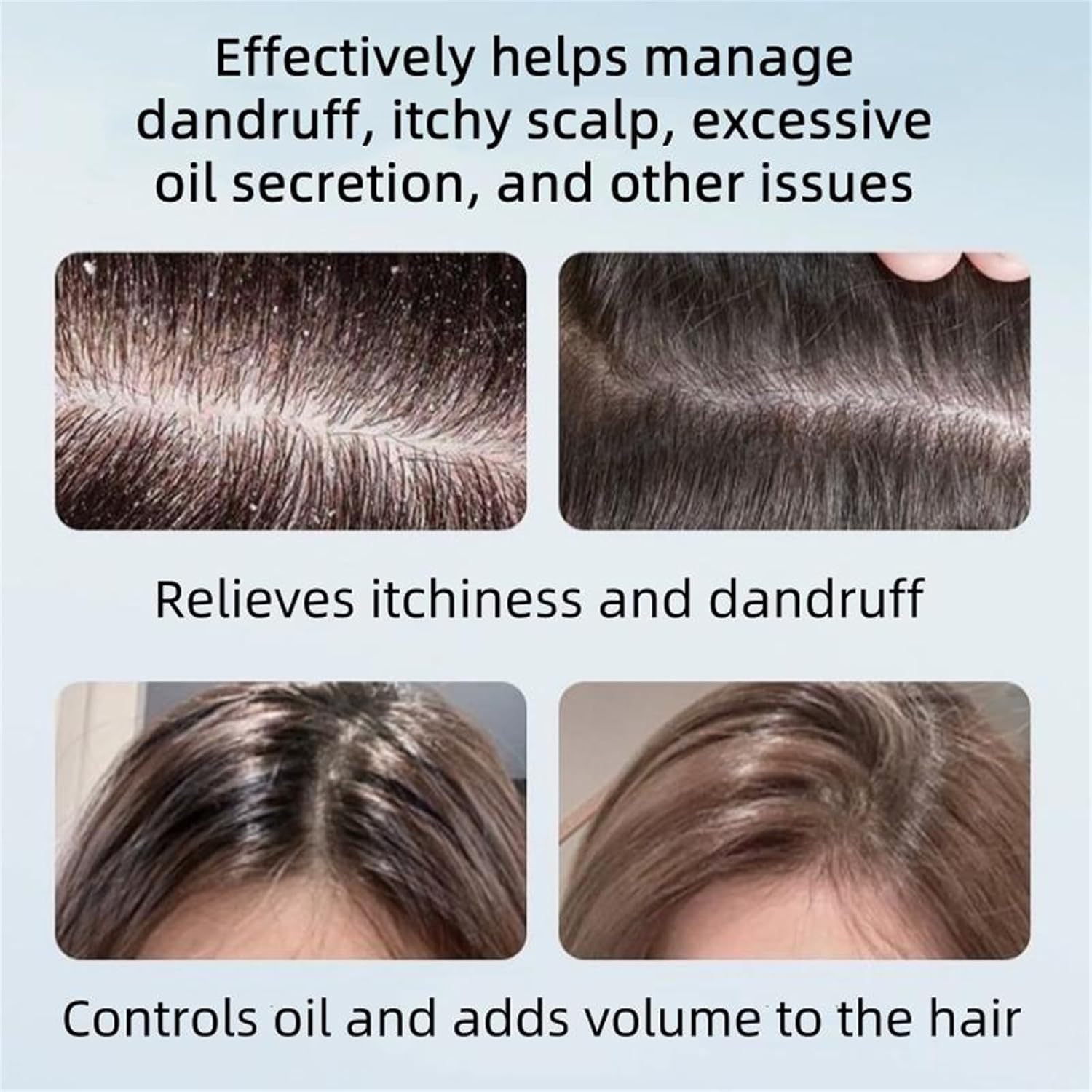 Anti-Dandruff Shampoo, Oil Control Refreshing Hair Care Cleansing Shampoo for Men and women (2PCS-8Fl.Oz) - Image 2