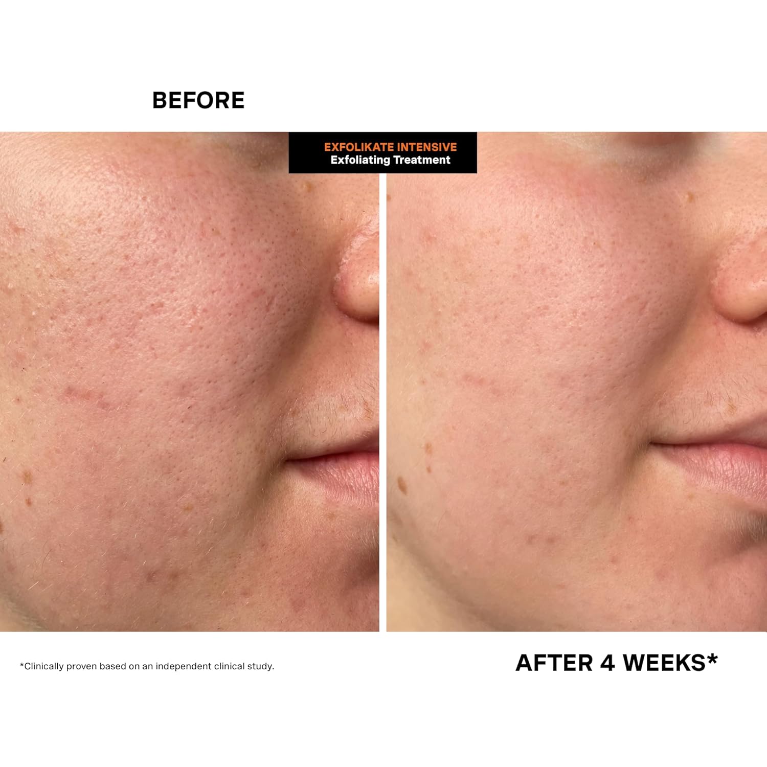 Kate Somerville ExfoliKate Intensive Exfoliating Treatment – Salicylic Acid and Lactic Acid Super Facial Scrub Improves Texture and Pores, 0.5 Fl Oz - Image 9