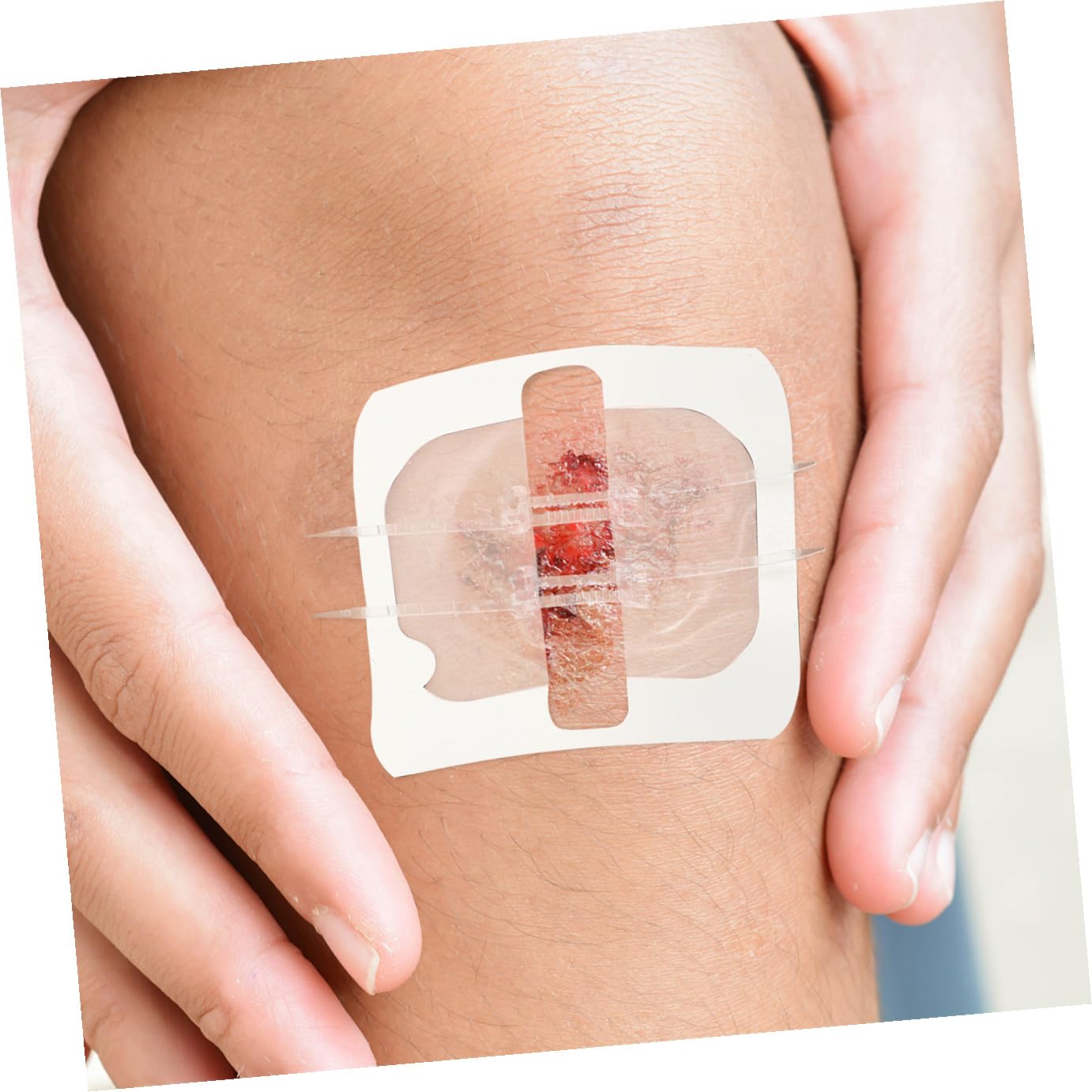 PLAFOPE 2piezas Cierre De Heridas Tiras Adhesivo Para Heridas y Exteriores Fácil De Usar
