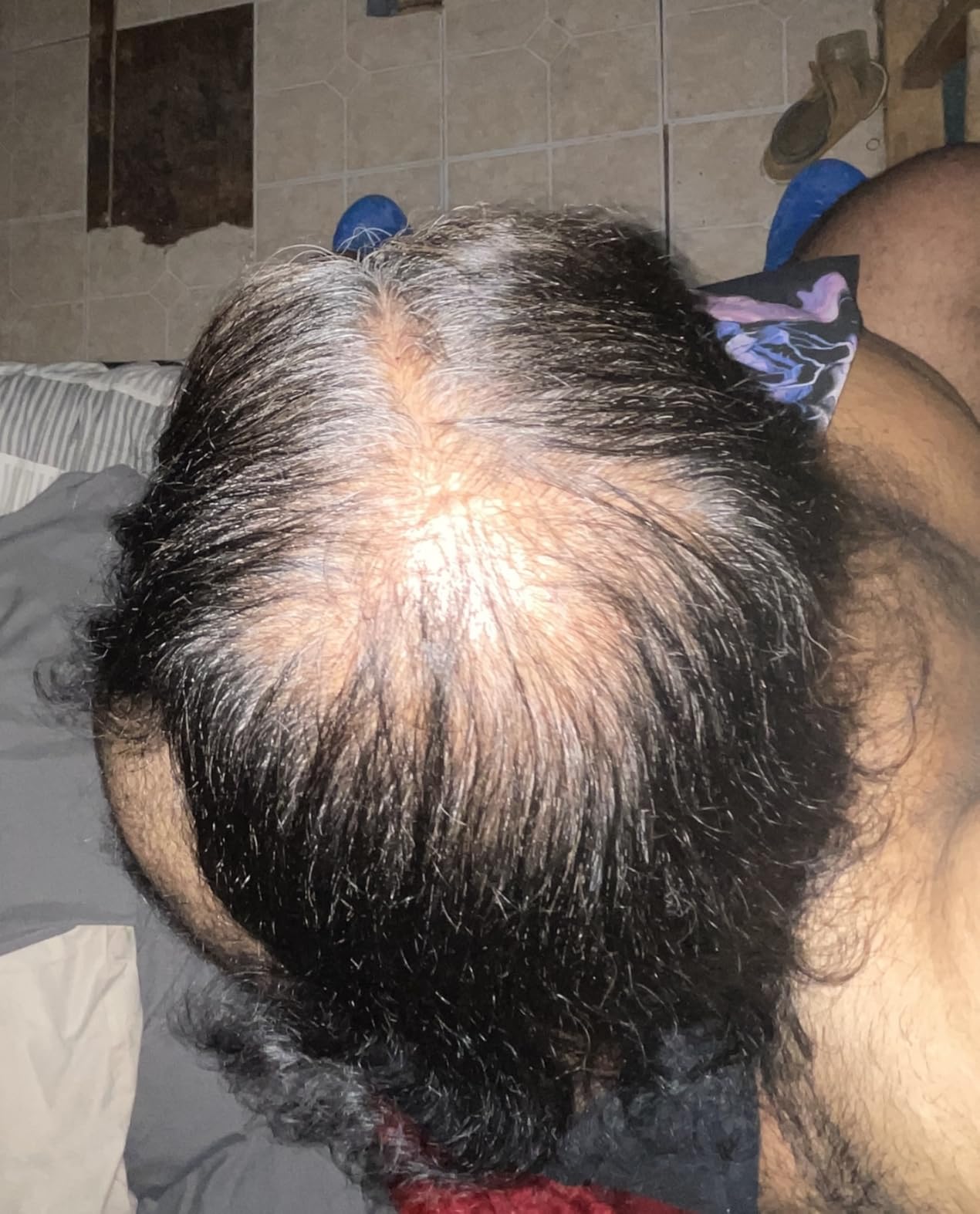 Inicio del Tratamiento - Minoxidil Kirkland Argentina