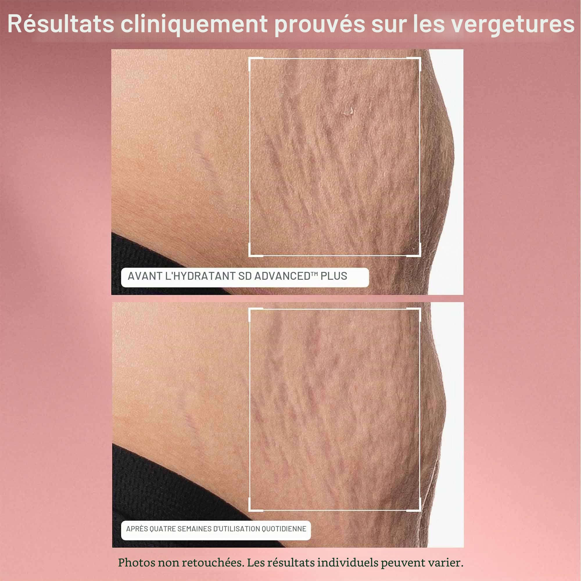 SD Advanced™ Plus Soin Hydratant Intensif Anti-Rides et Anti-Vergetures 118ml