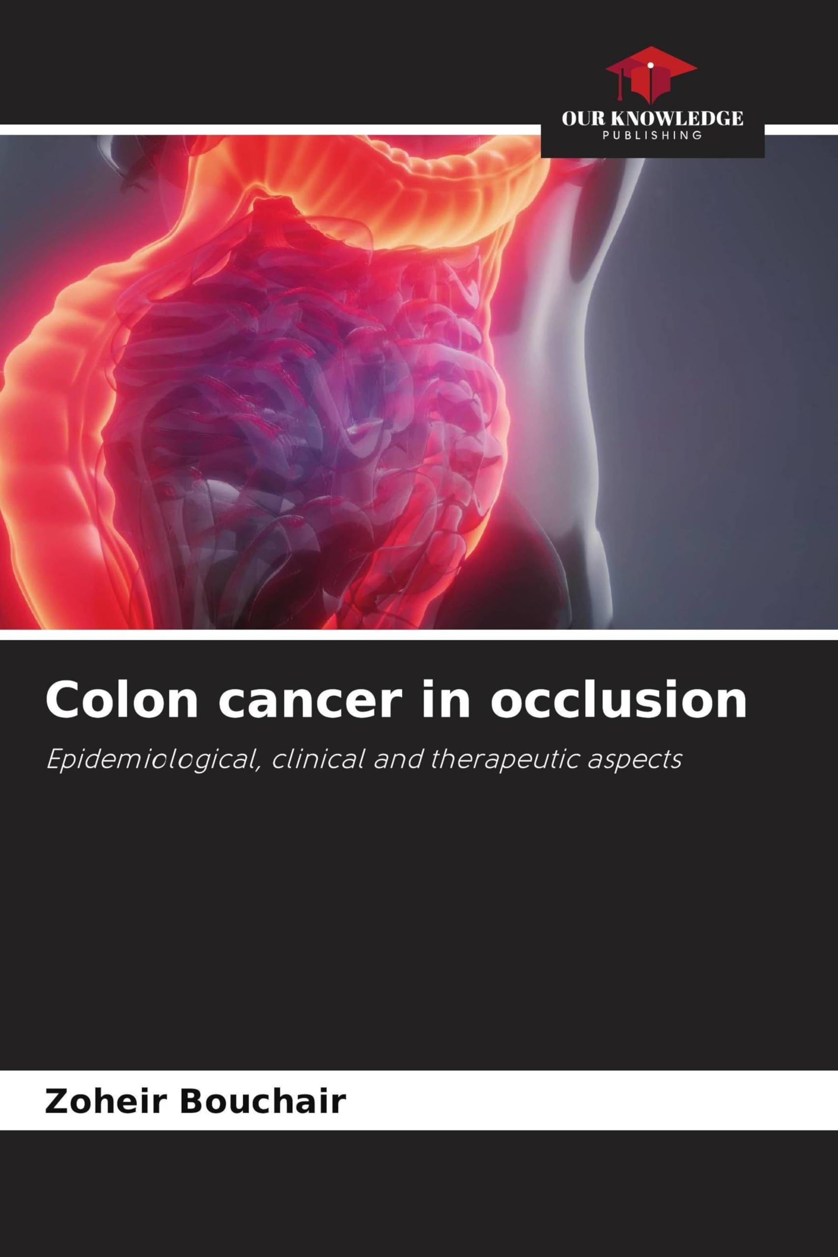 Colon cancer in occlusion: Epidemiological, clinical and therapeutic aspects