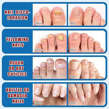 Fungal Nail Treatment For Toenails, Nail Fungus Treatment for Thick, Broken, Brittle Nails, Supports Healthy Growth 30 ml