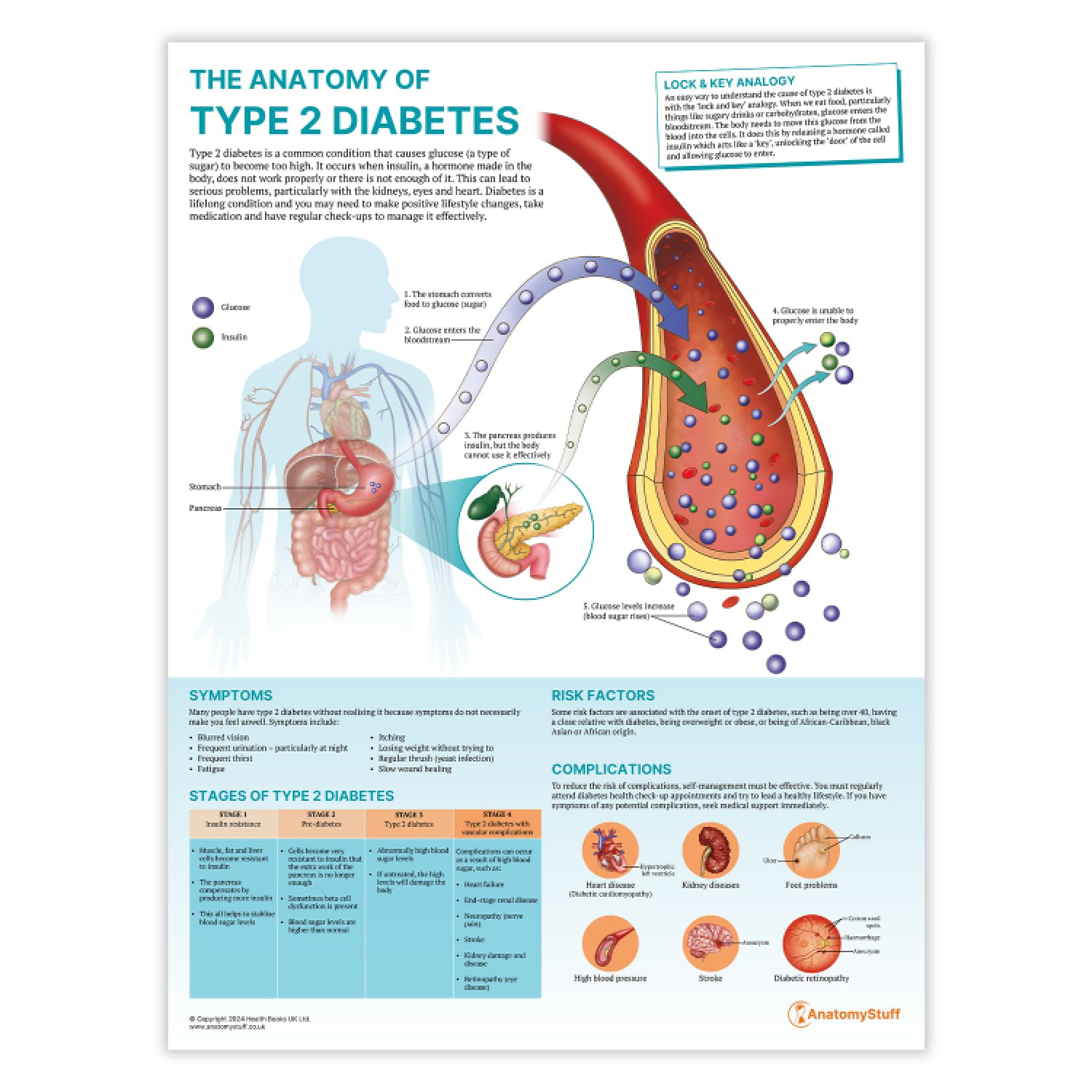 Anatomy Stuff Type 2 Diabetes The Anatomy Of Poster, 45X60 Cm, 18X24 Inches, Diabetes Anatomical Chart, Mellitus Diagram