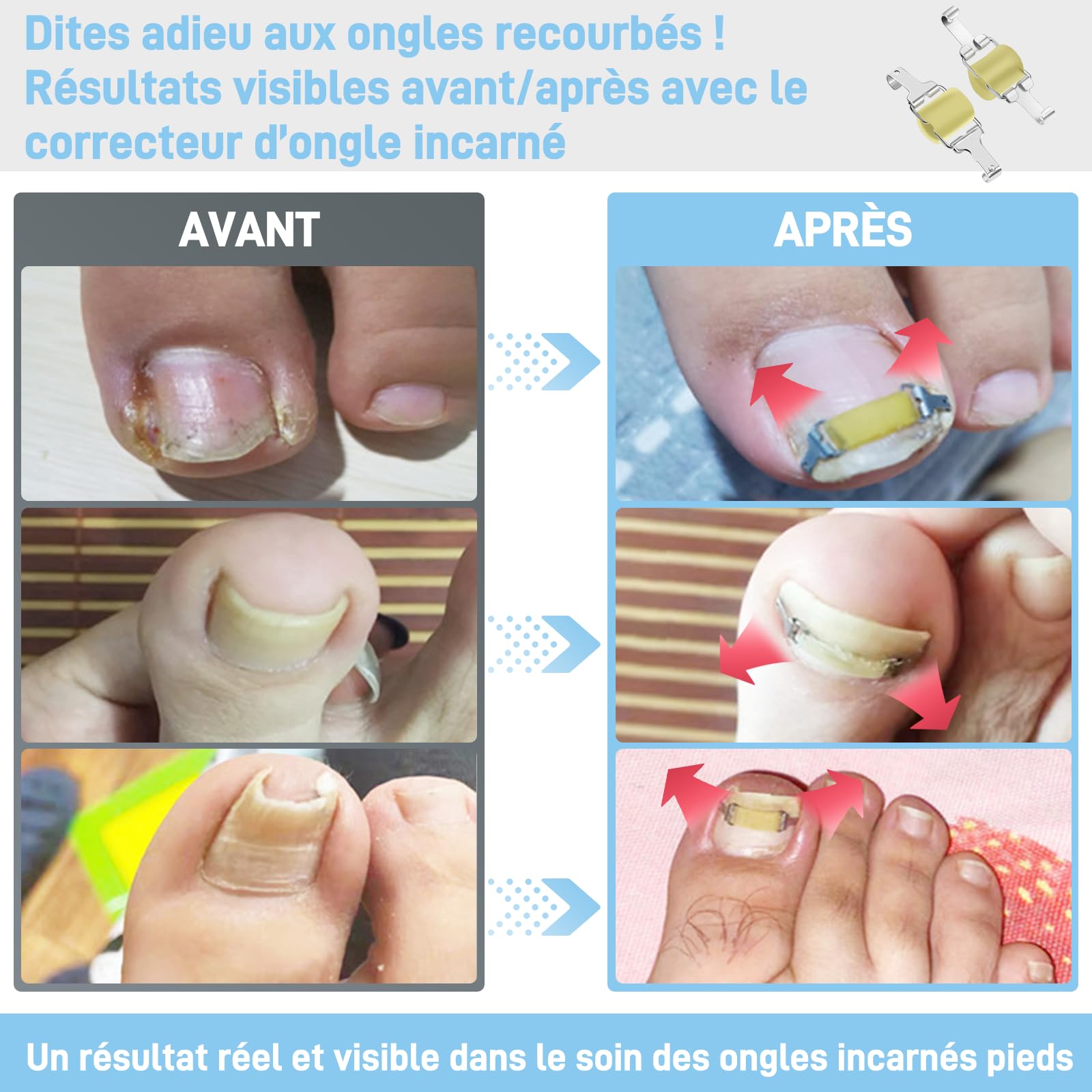 InhwRior Correcteur d’ongle incarné,facile à utiliser à la maison, stable et sûr, sans glissement, traction continue pour un soulagement rapide de la douleur, étanche pour la douche(19mm-21mm)