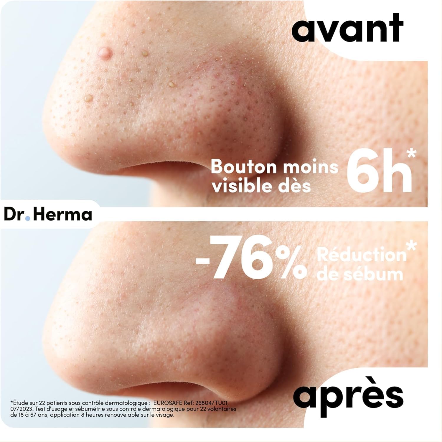 Dr. Herma - Patch Anti Bouton - Adapté au Nez - Résultats en 6 à 8h - Testé sous contrôle dermatologique - Acide Salicylique, Hydrocolloïdes, Huile d'Arbre à Thé - 2 Boîtes de 10 patchs