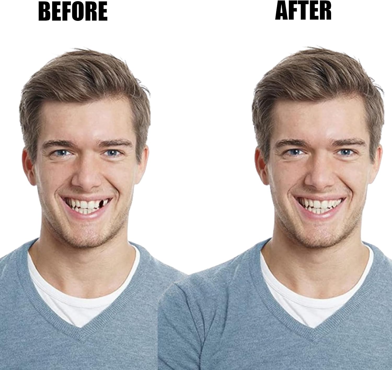 Temporary Tooth Veneer Crowns Kit – 100PCS/Box (50 Anterior + 50 Posterior) – DIY Fake Teeth Cap for Missing Teeth & Natural-Looking Smile Restoration for Holiday Cosplay