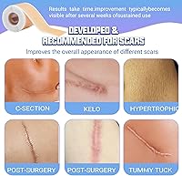 Vista 7 de Hojas de silicona para cicatrices, cinta de silicona para cicatrices, parches de cicatrices de silicona para cicatrices quirúrgicas, cesárea