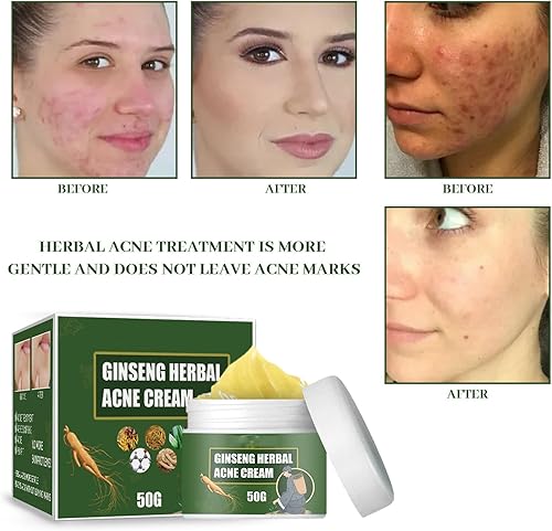 Miniatura 8 de Mnpalettey Crema herbaria del acné del ginseng, crema eliminadora del acné de hierbas, crema de acné a base de hierbas lejos de las marcas del acné