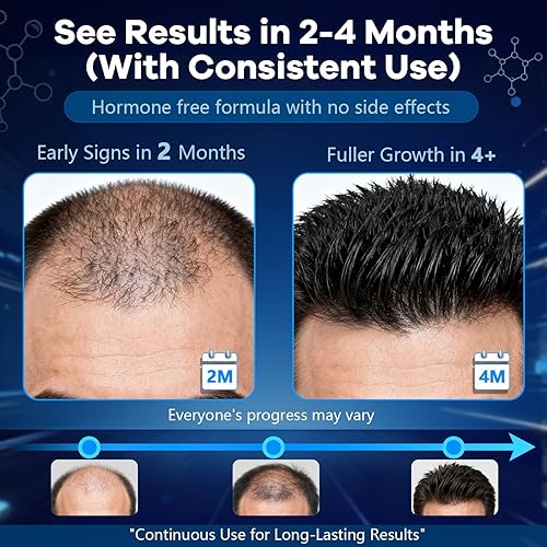 Miniatura 6 de Espuma tópica de minoxidil al 5 %, aerosol de minoxidil para hombres, impregnado con biotina, tratamiento para el crecimiento del cabello, apoya el