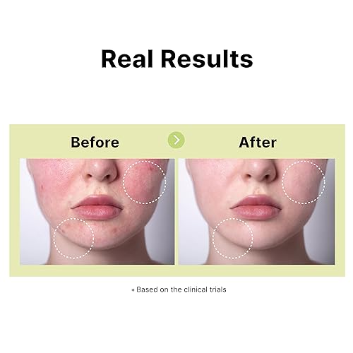 Miniatura 4 de DearMYDEW Suero de ácido azelaico 10% con niacinamida, ácido salicílico, alantoína, tratamiento de rosácea para aliviar el enrojecimiento facial,