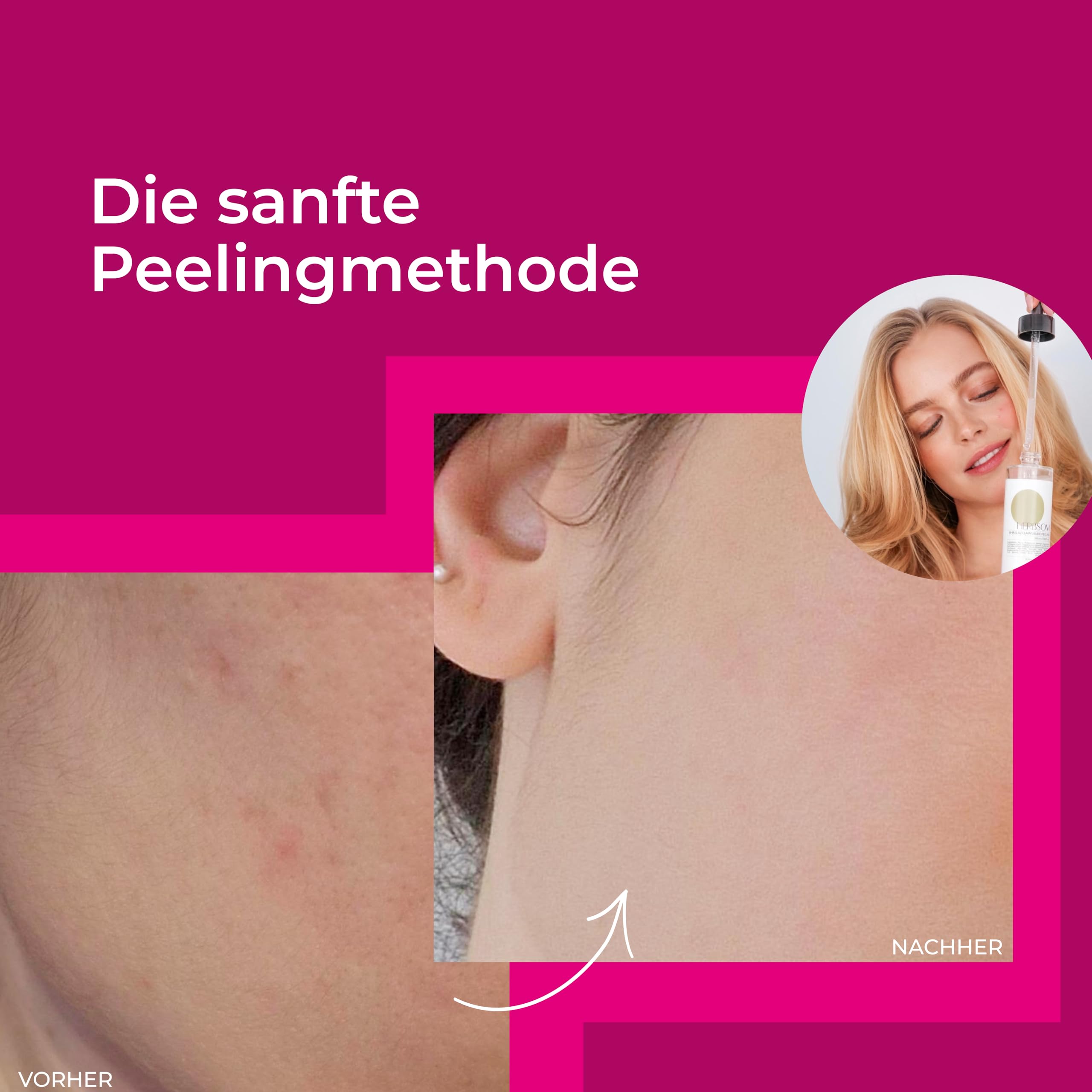 BHA & Azelainsäure Peeling I reinigt porentief, gegen verstopfte Poren und Unreinheiten, für sichtbar reinere und ebenmäßigere Haut, besonders geeignet für Mischhaut und fettige Haut