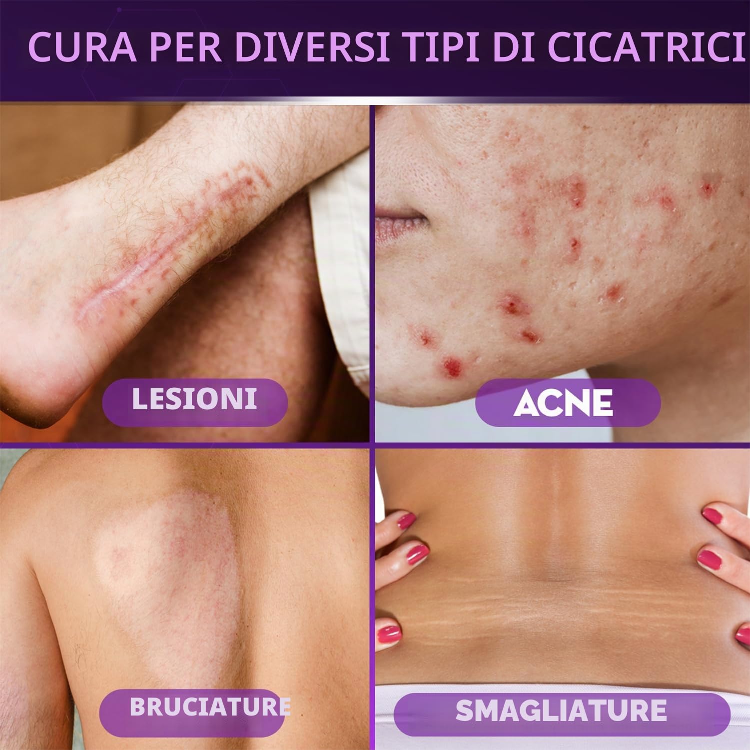 Cicatricure Gel per cicatrici viso e corpo, riduce la comparsa di cicatrici vecchie e nuove, smagliature, chirurgia, lesioni, ustioni e acne, 28,3 g (la confezione può variare)