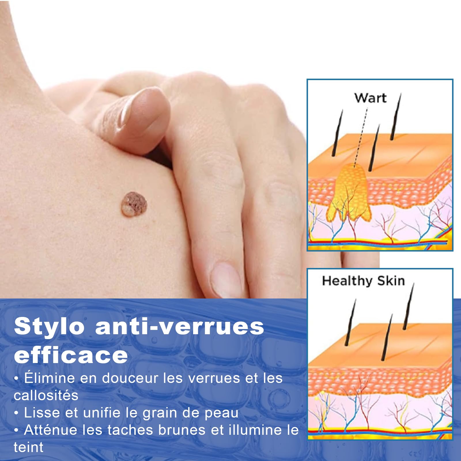 Stylo anti-verrues 2Pcs (4ml) pour le corps et les mains