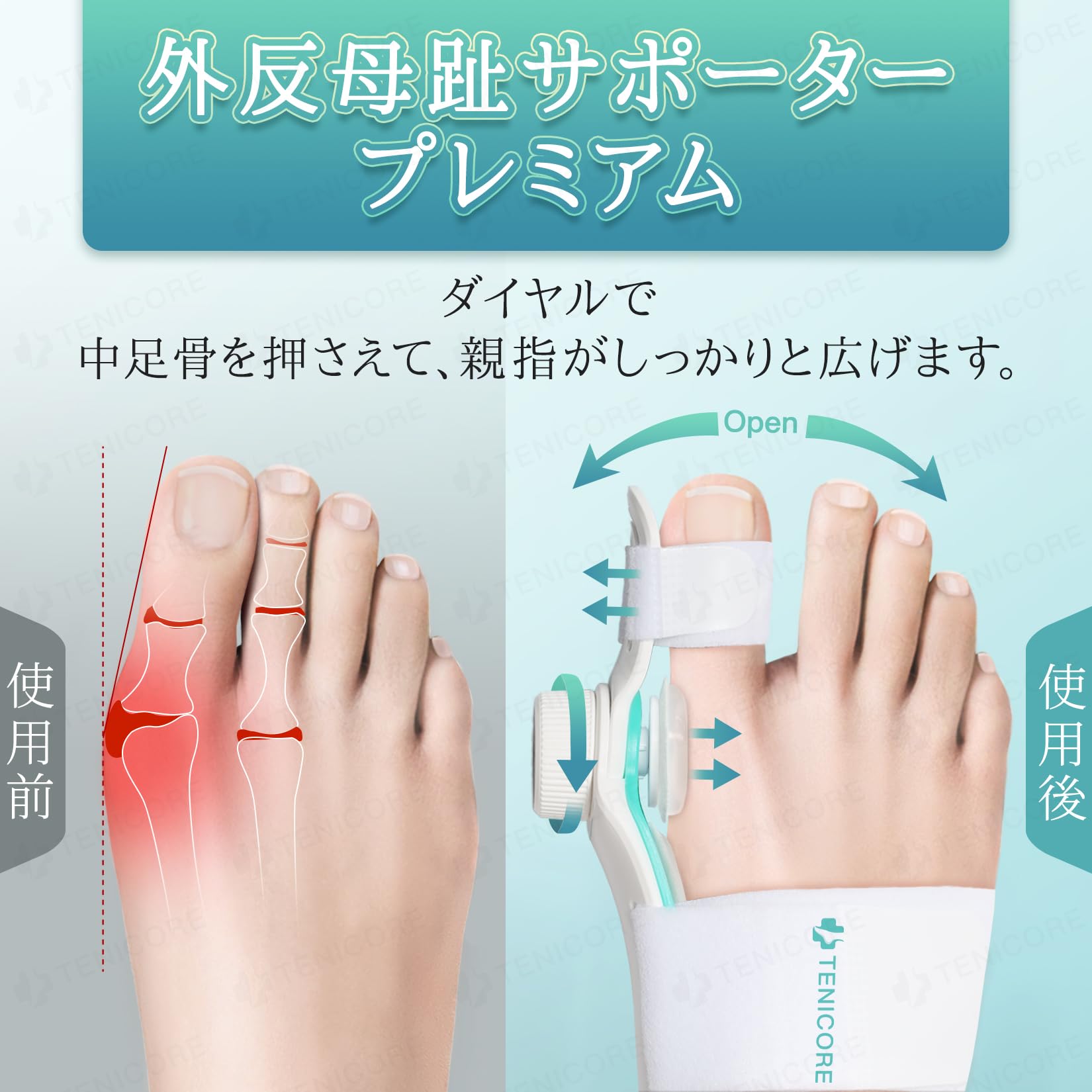 【在庫処分】【二重調整の外反対策】Tenicore 外反拇指サポーター ダイヤル Amazon | 【二重調整の外反対策】Tenicore 外反拇指サポーター