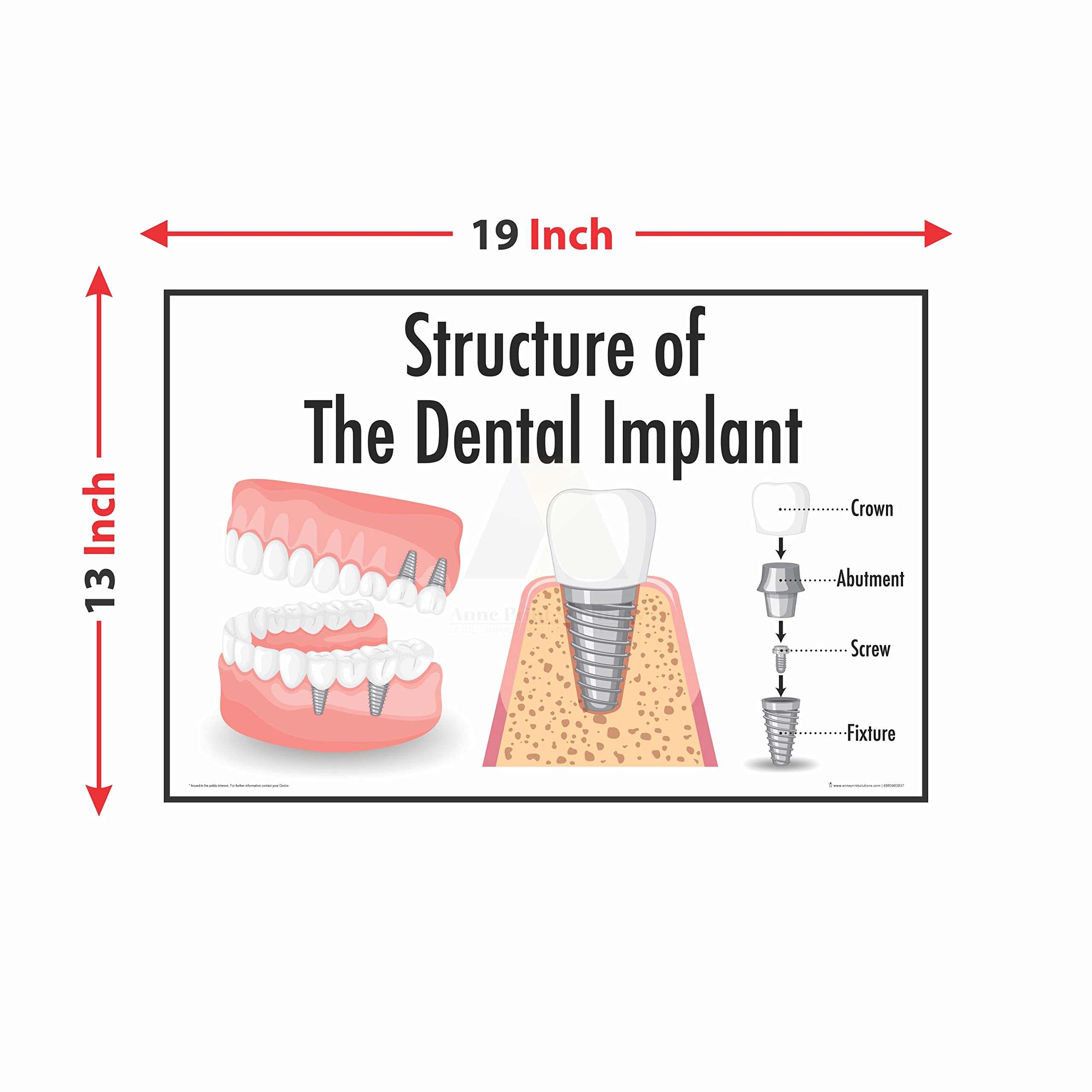 Dental Implant Chart Poster - Healthcare Reference -2